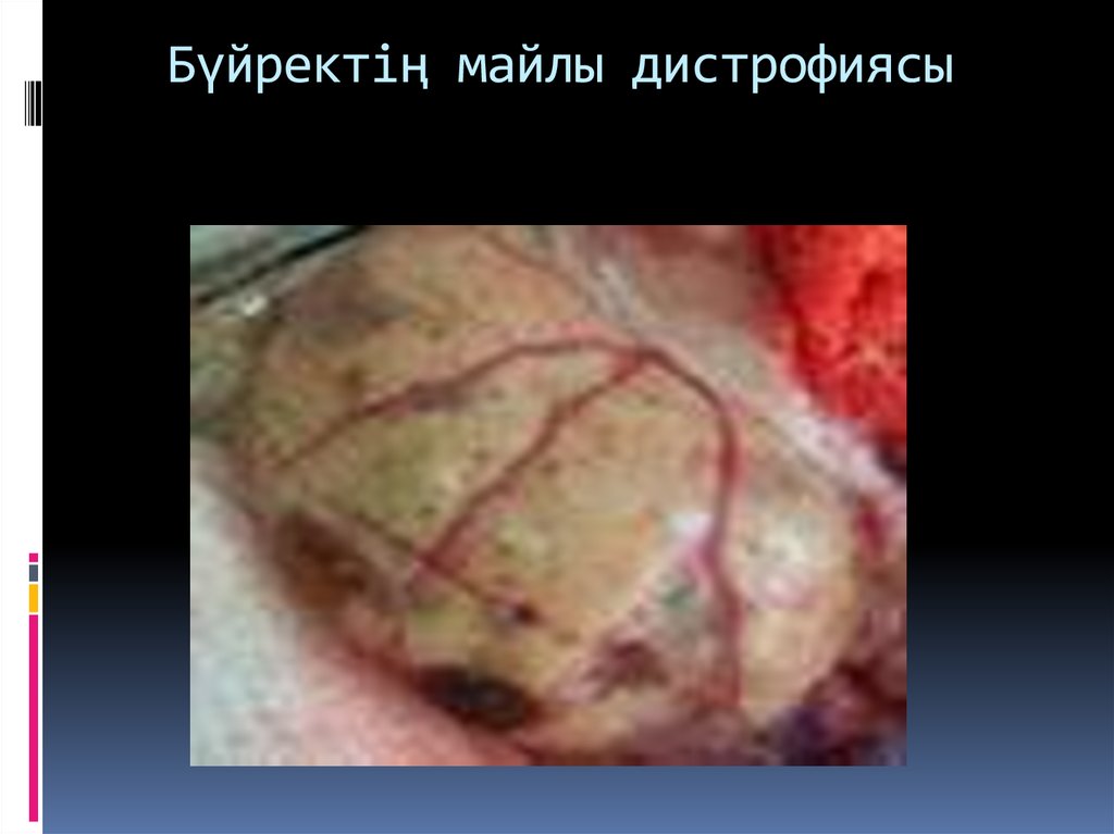 Бүйректің майлы дистрофиясы