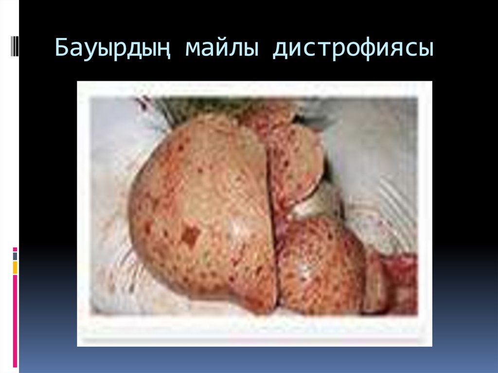 Бауырдың майлы дистрофиясы