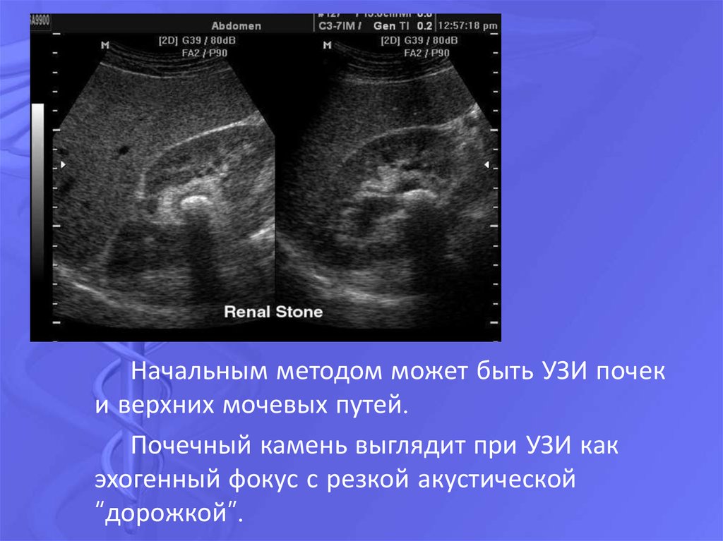 Узи почек и мочевого пермь. Конкременты в почках на УЗИ что это такое. Верхний полюс почки на УЗИ. Камни в почках по УЗИ. УЗИ мочевыводящих путей.