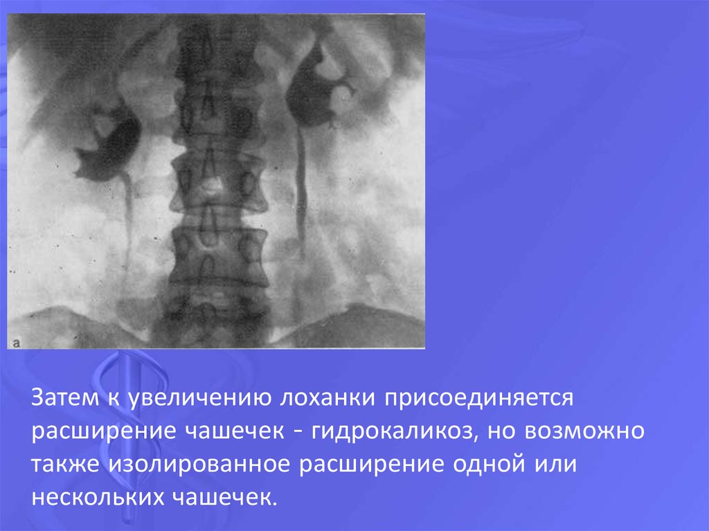 Расширенная лоханка форум. Гидрокаликоза правой почки. Гидрокаликоз почек что это такое. Левосторонний гидрокаликоз. Гидрокаликоз левой почки.