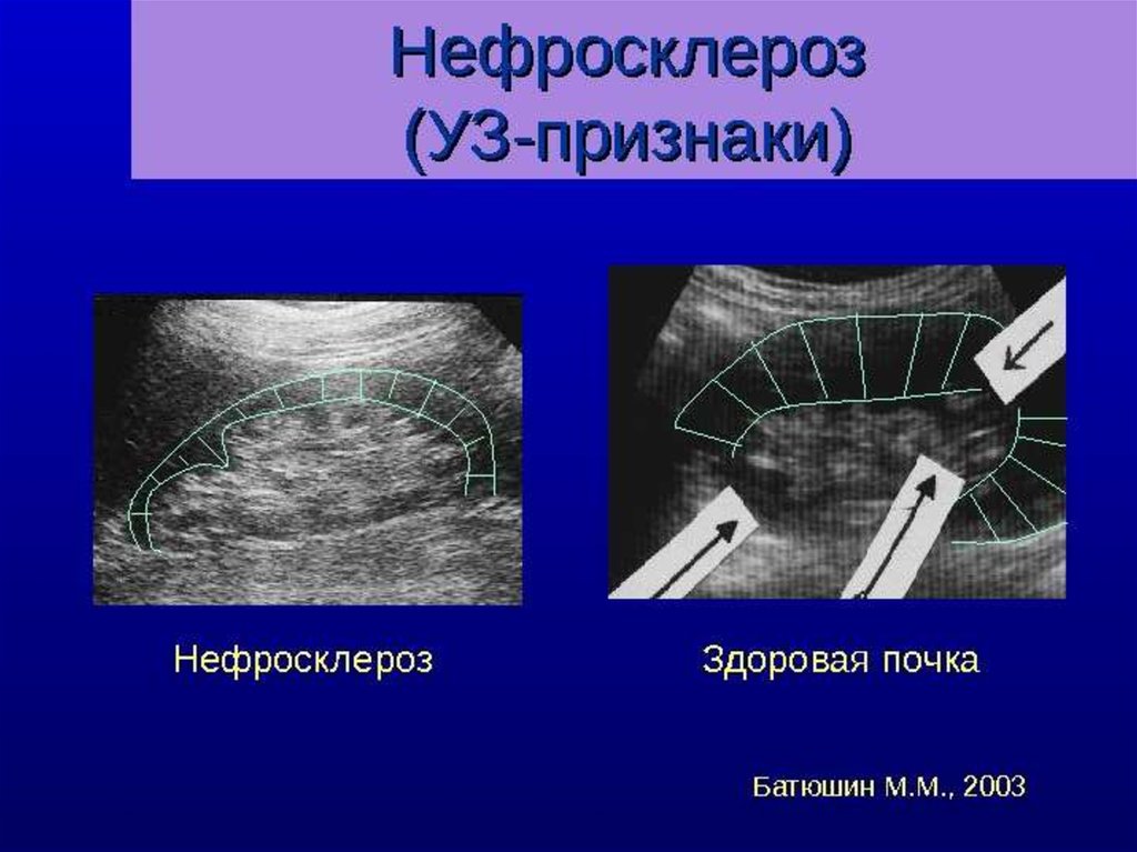 Уз признаки. Вторично сморщенная почка на УЗИ. Гипертонический нефросклероз УЗИ. Вторично сморщенная почка на УЗИ признаки. Нефросклероз почек на УЗИ что это такое.