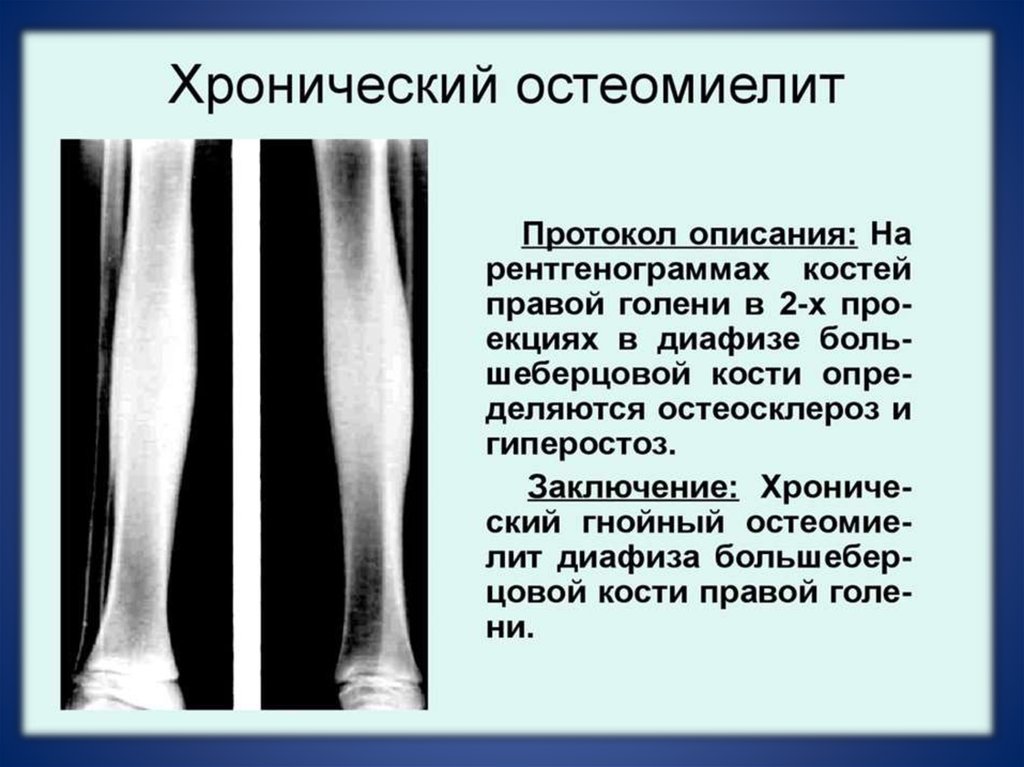 Рентгенологическая картина остеомиелита