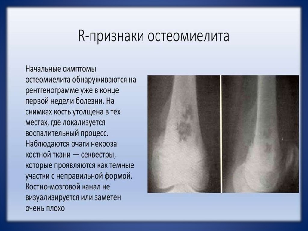 Рентгенодиагностика остеомиелита презентация