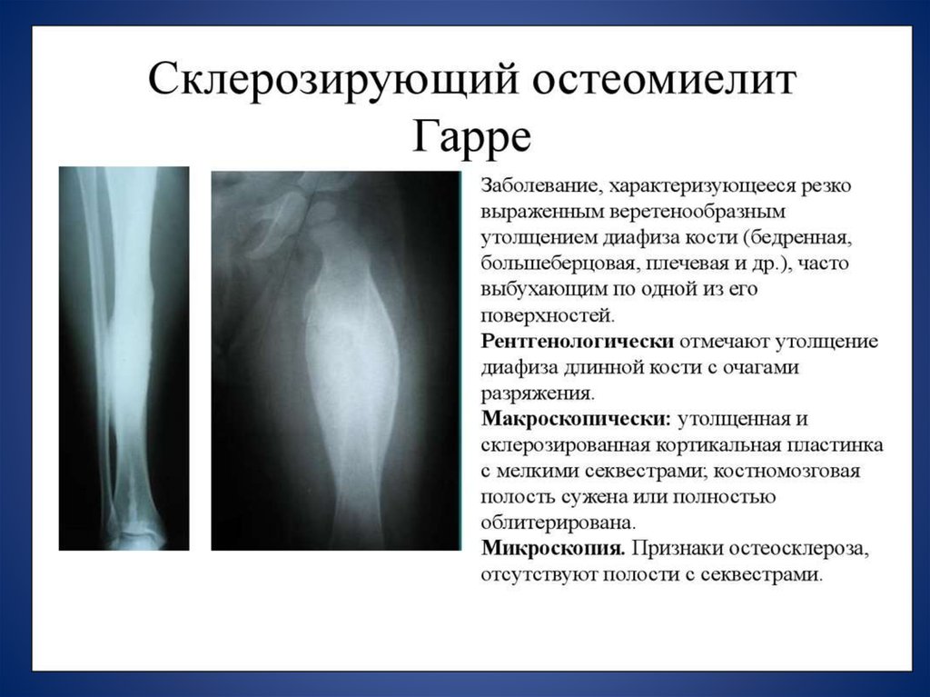 Вывихи рентгенологические признаки