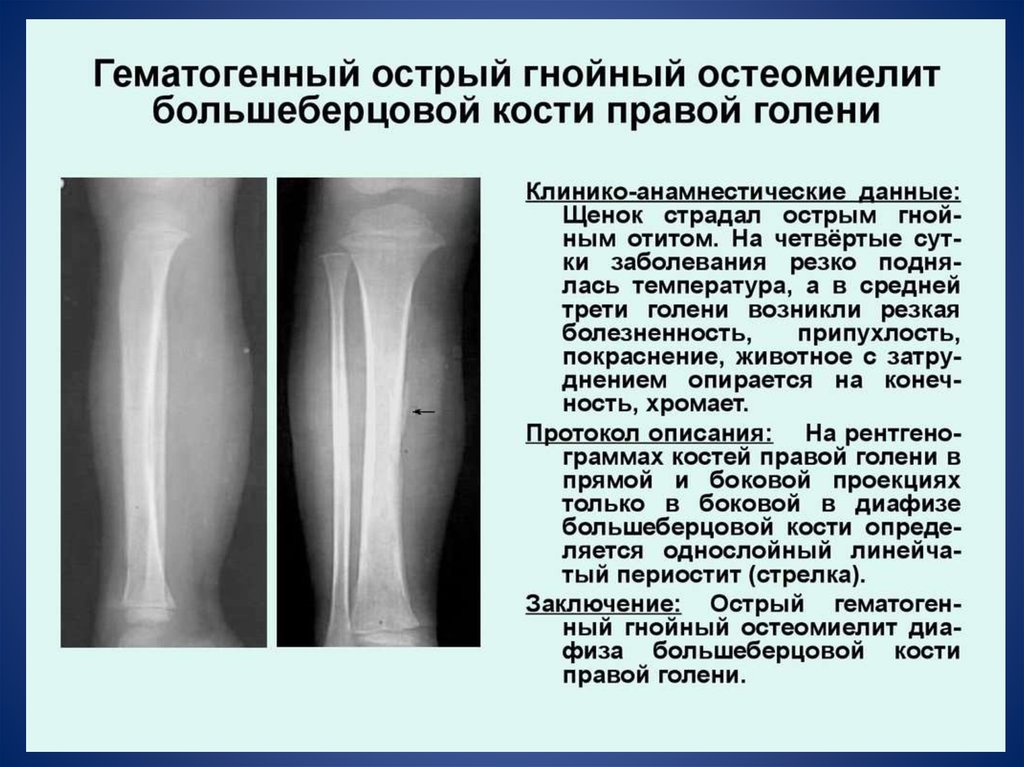 Рентгенологическая картина остеомиелита