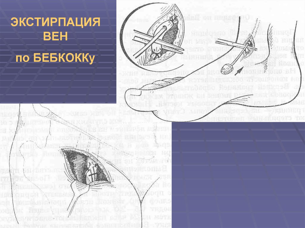 Экстирпация это. Операции на венах топографическая анатомия. Топографическая анатомия ПБС. Прием Губарева топографическая анатомия.