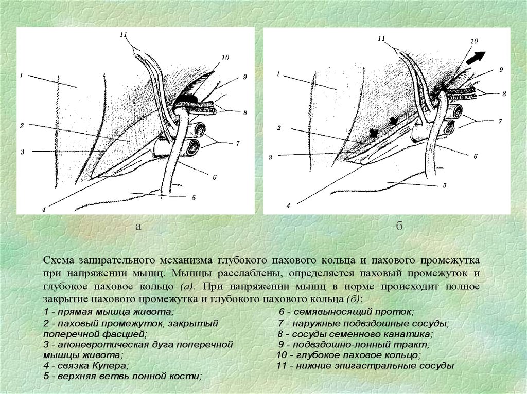 Способ кукуджанова при паховых грыжах схема - 80 фото