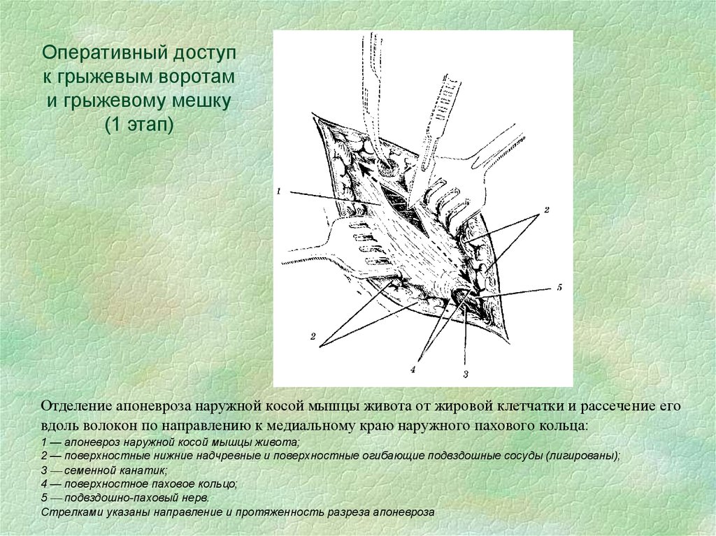 Грыжа брюшной стенки фото