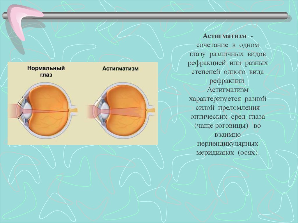 Астигматизм оптической системы. Рефракция глаза астигматизм. Оптические среды глаза преломляющие. Рефракция глаза это. Рефракция и аккомодация.