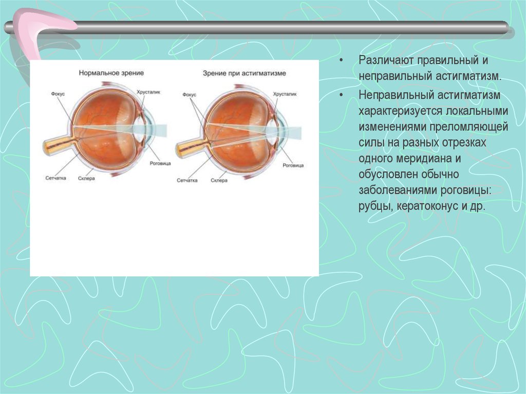 Рефракция в двух главных меридианах. Неправильный астигматизм. Правильный и неправильный астигматизм. Кератоконус и астигматизм. Понятие рефракции, аккомодации и адаптации глаза.