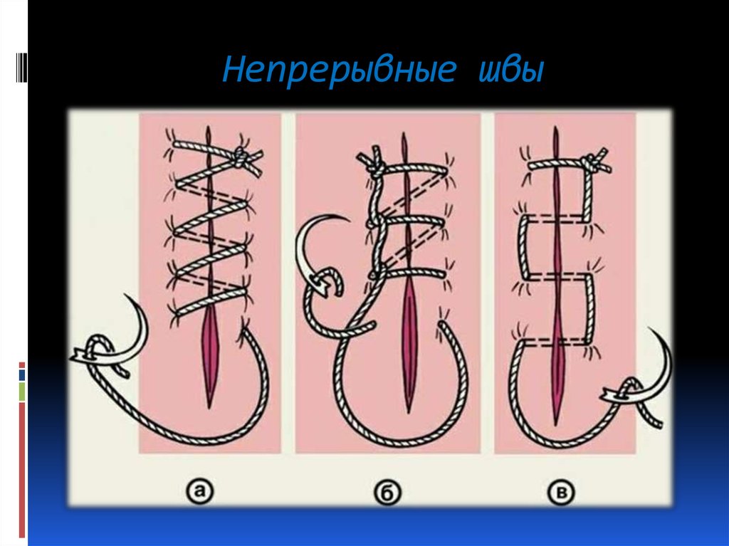 Шов донати схема