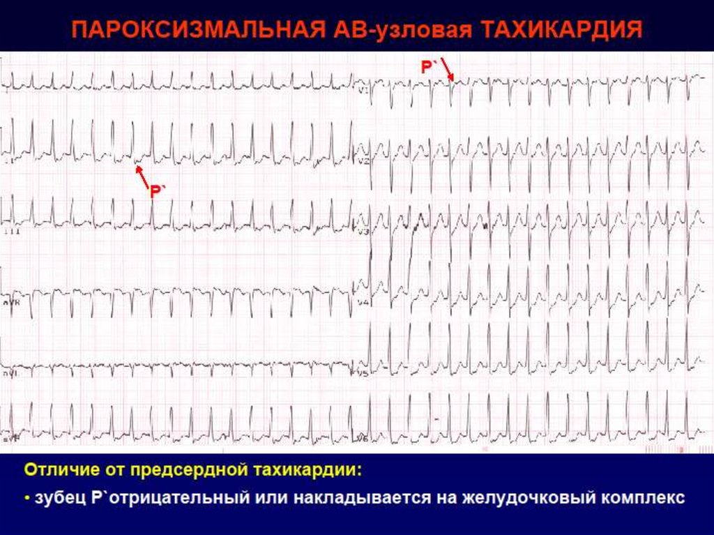 Пароксизмальная тахикардия на экг. АВ Узловая пароксизмальная тахикардия на ЭКГ. Пароксизмальная тахикардия предсердий ЭКГ. Узловая пароксизмальная тахикардия на ЭКГ. ЭКГ ритм пароксизмальная тахикардия.