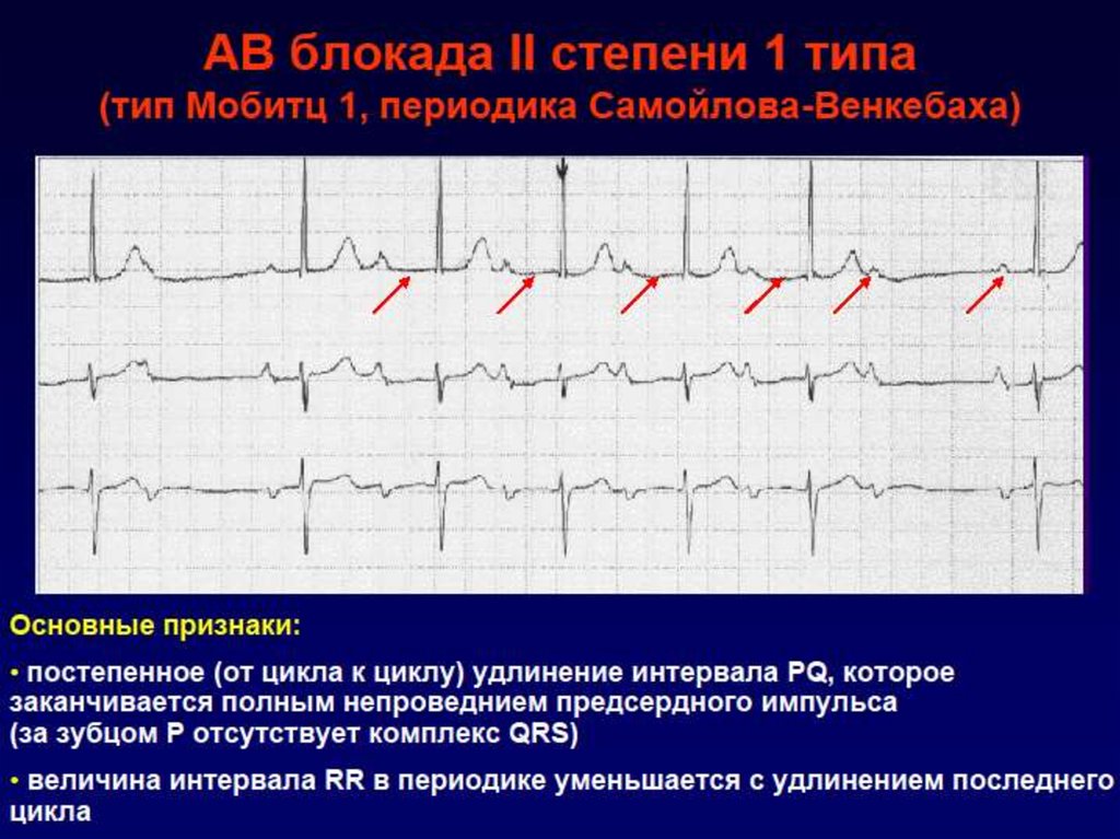 Неполная блокада предсердия. Блокада 3 степени ЭКГ. ЭКГ признаки АВ блокады 2 степени Мобитц 1.