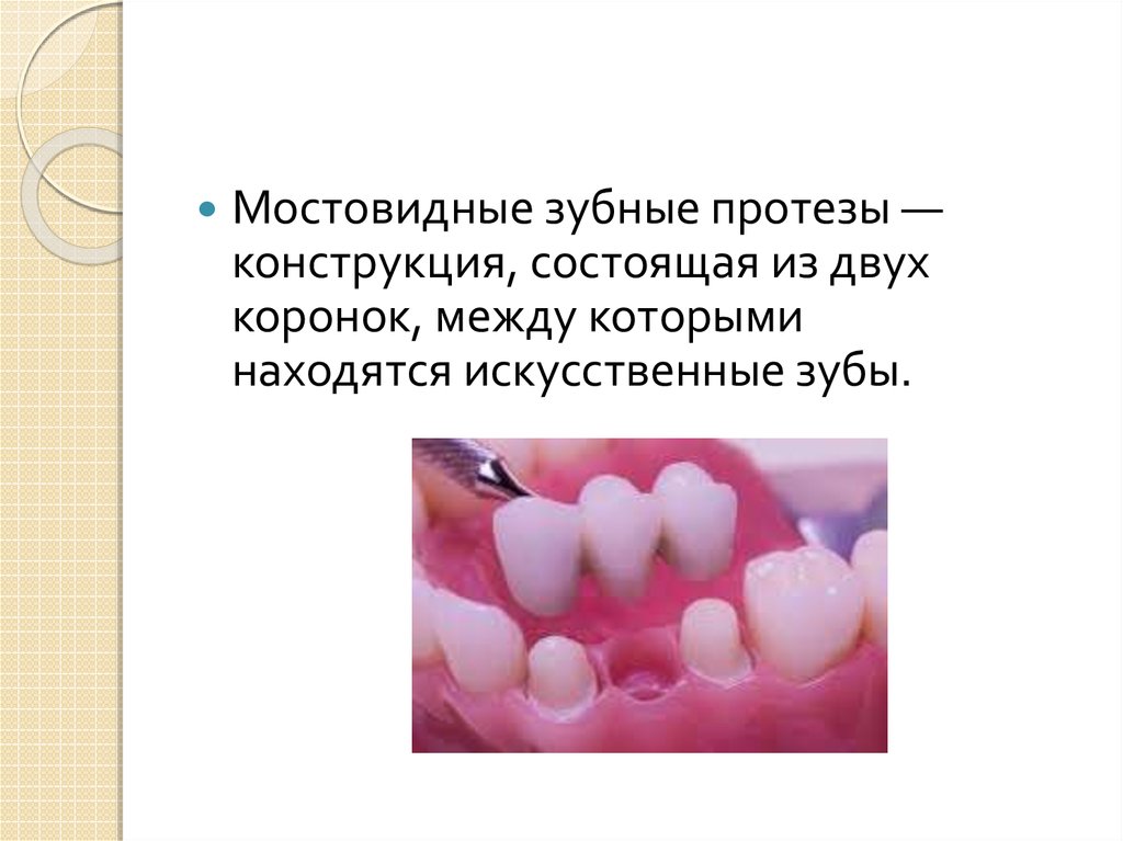 Протез презентация. Детское зубное протезирование презентация. Показания к изготовлению мостовидных протезов.