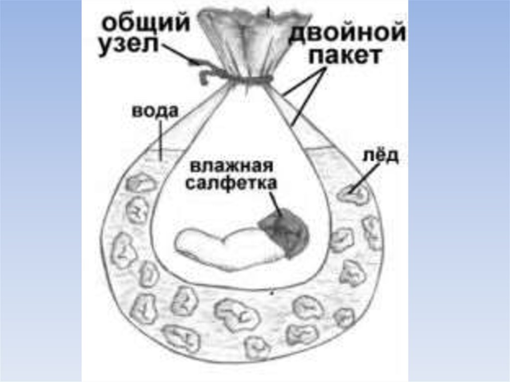 Травматическая ампутация голени карта вызова