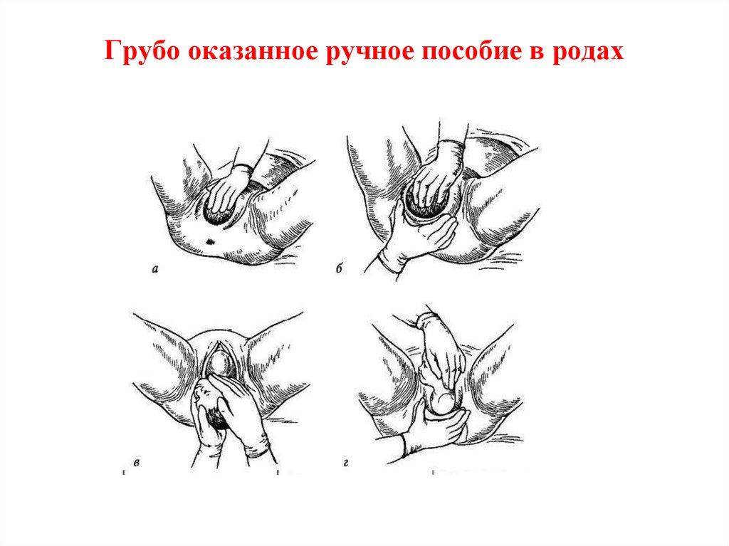 Акушерское пособие. Приемы ручного пособия в родах. Оперативные пособия в родах.