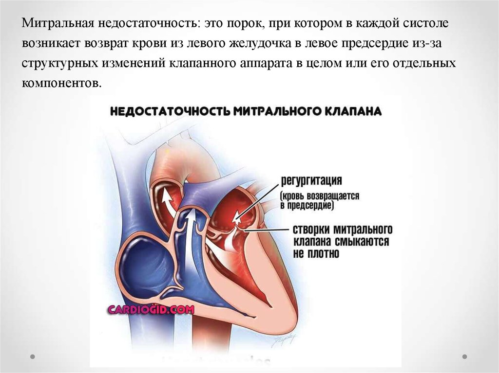 Поражение митрального клапана. Приобретённые пороки сердца недостаточность митрального клапана. Врожденный порок сердца дефект клапана. Врожденные митральные пороки сердца. Приобретенные митральные пороки сердца.