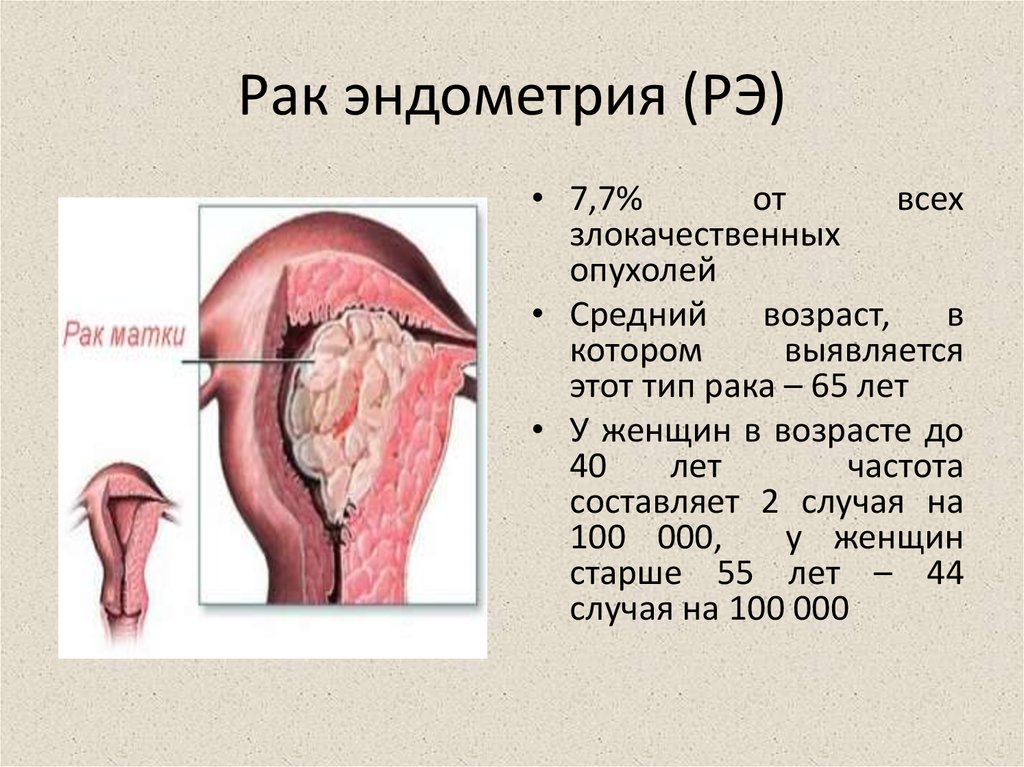 Новообразования эндометрия. Карцинома эндометрия матки.