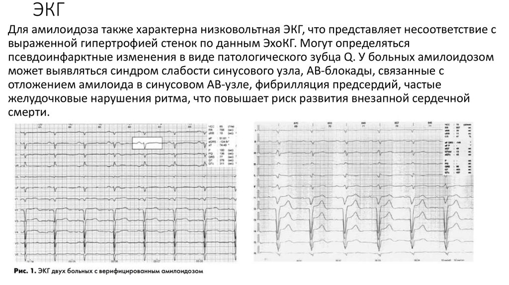 Экг при дилатационной кардиомиопатии фото