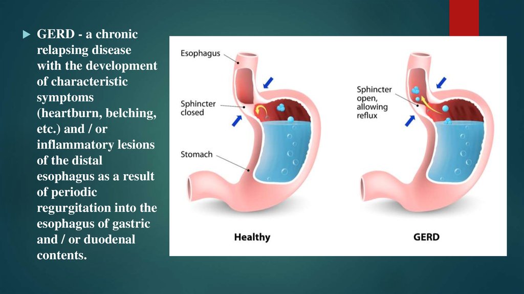 Gastroesophageal Reflux Disease GERD Online Presentation