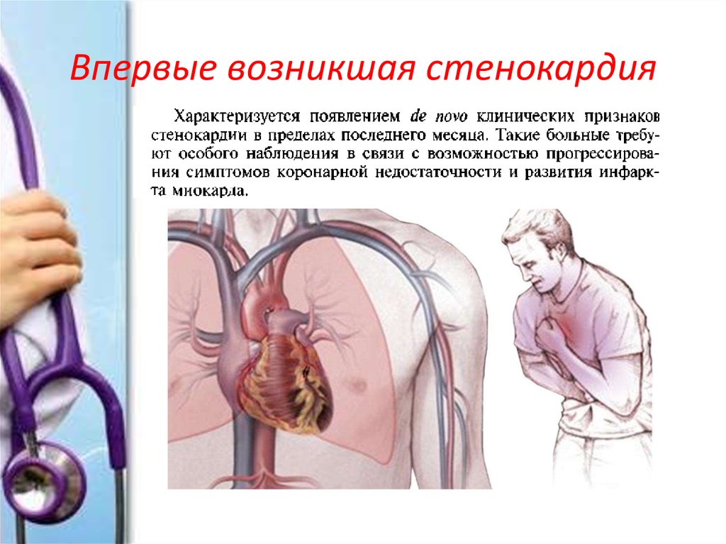 Стенокардия напряжения презентация