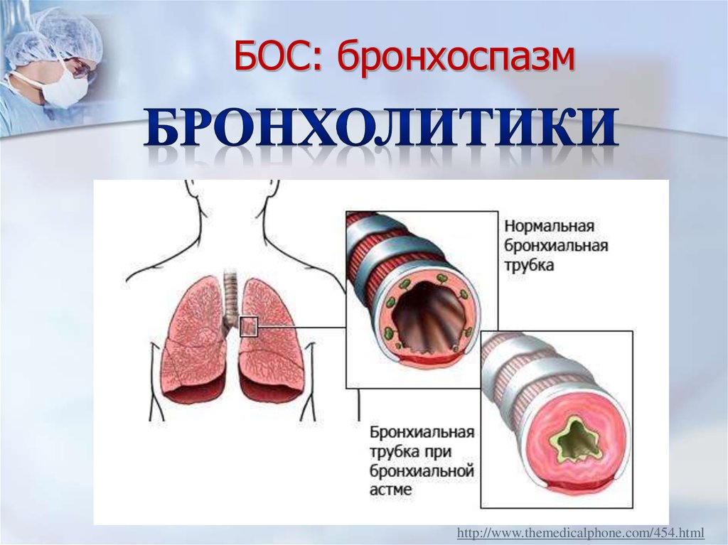 Чем снять бронхоспазм у взрослого. Бронхиальная обструкция и бронхоспазм. Сужение бронхов бронхоспазм. Спазм бронхов при бронхиальной астме.