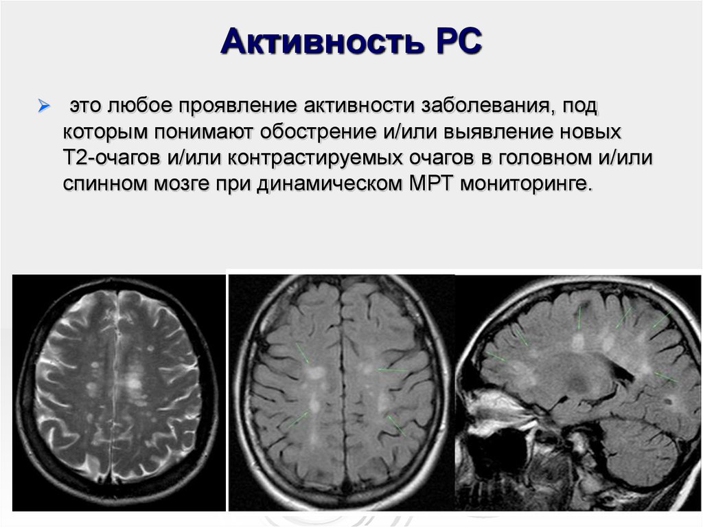 Склероз мозга симптомы