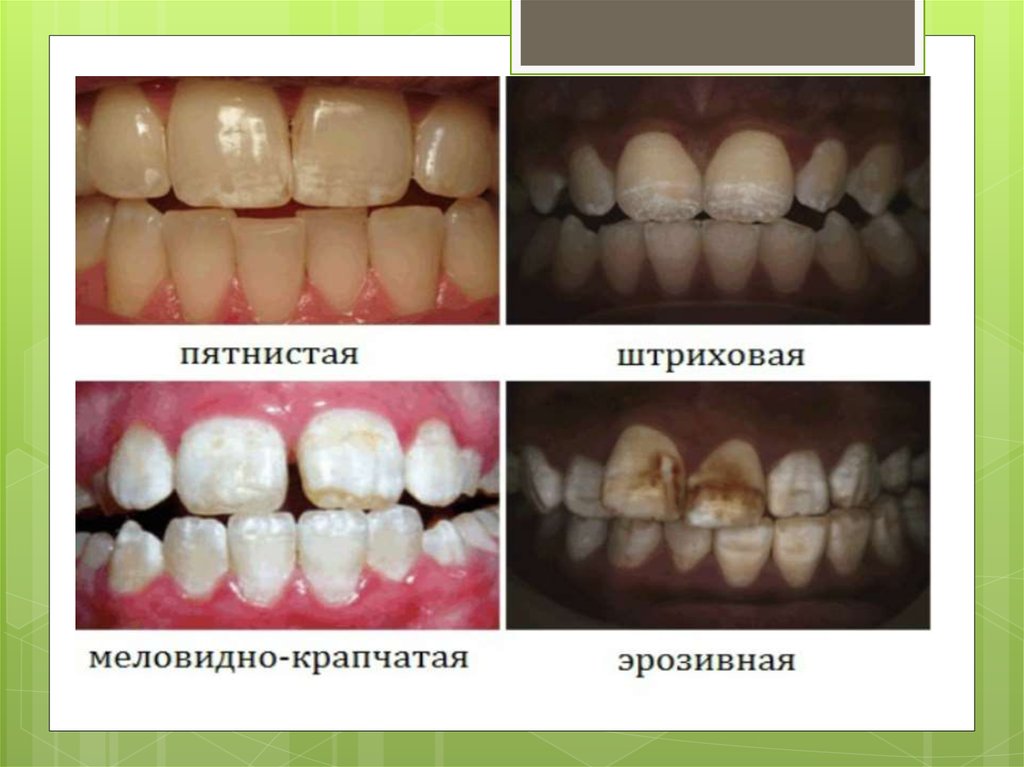 Флюороз и гипоплазия фото