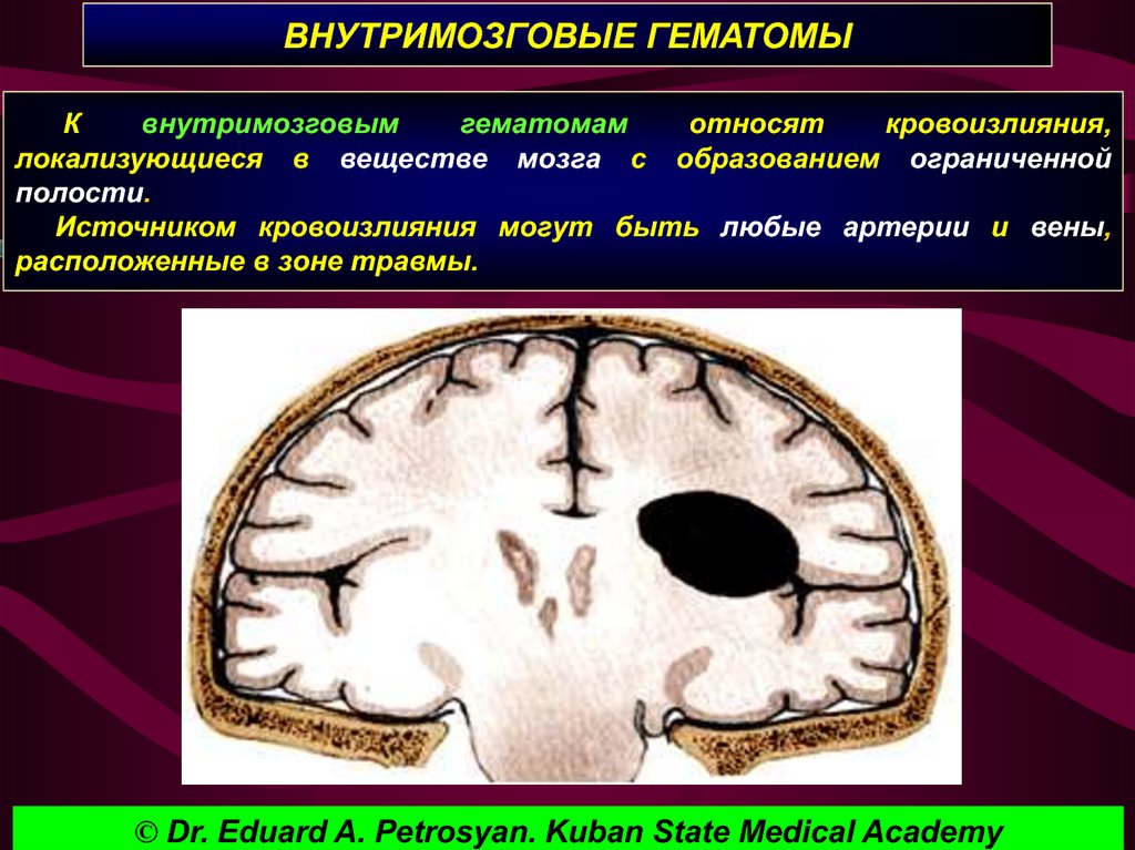 Проведенные на головном мозге. Внутримозговая гематома. Внутримозговые тератомы. Внутримозговое кровоизлияние. Внутримозговая гематома головного мозга.
