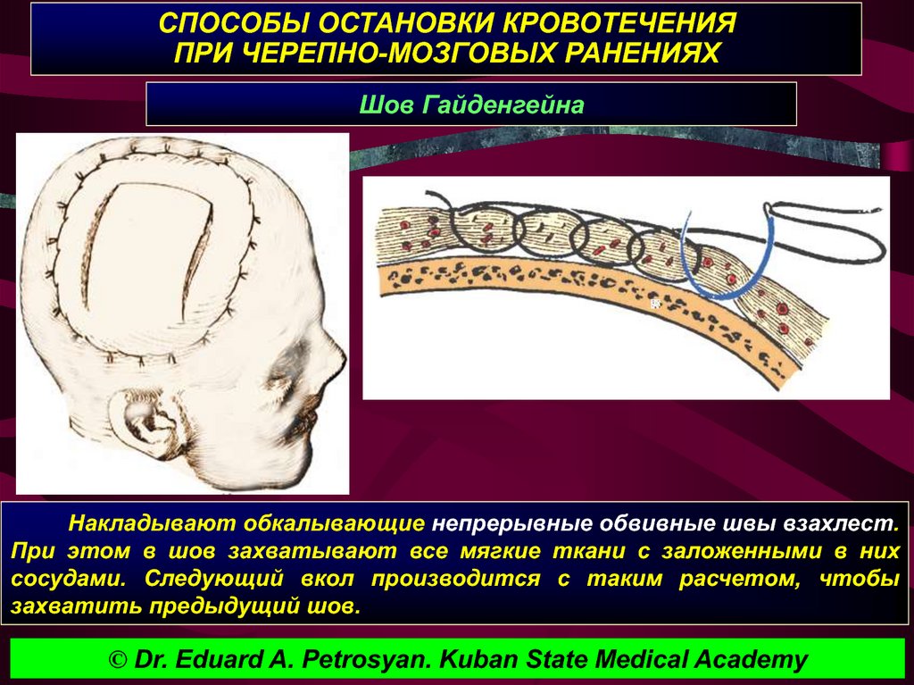 Кровотечения при ранениях головы. Шов мягких тканей мозгового отдела головы. Остановка кровотечения из мягких тканей черепа. Способы остановки кровотечения при операциях на черепе. Операции на мозговом отделе головы.