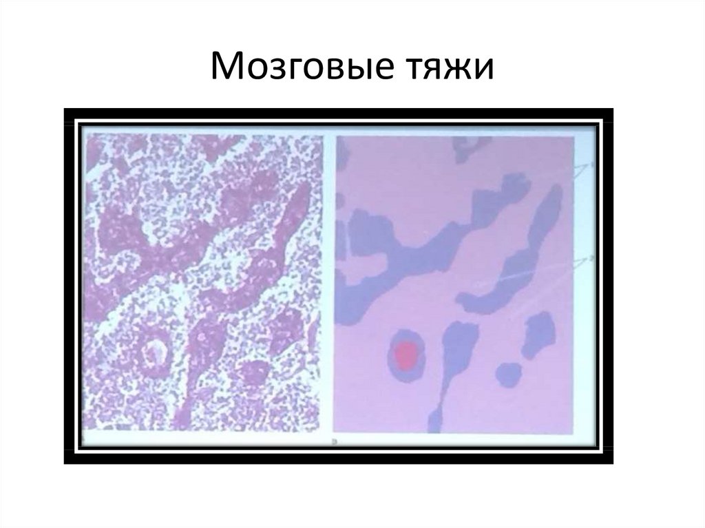 Мозговые тяжи