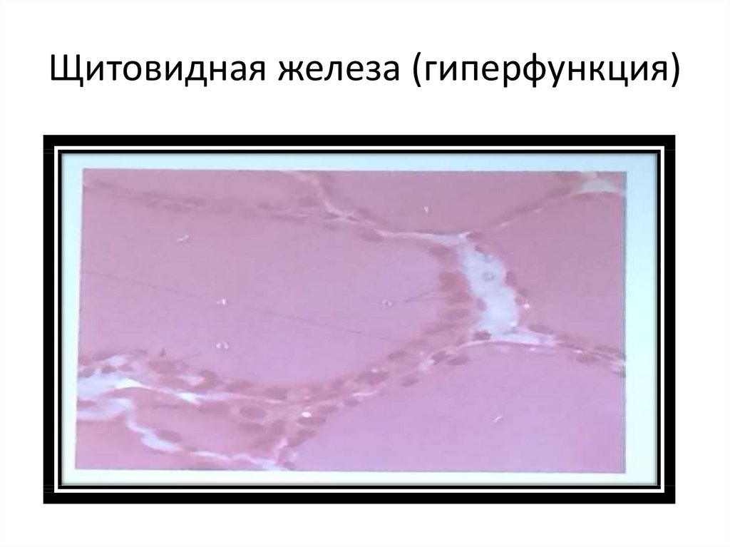 Щитовидная железа (гиперфункция)