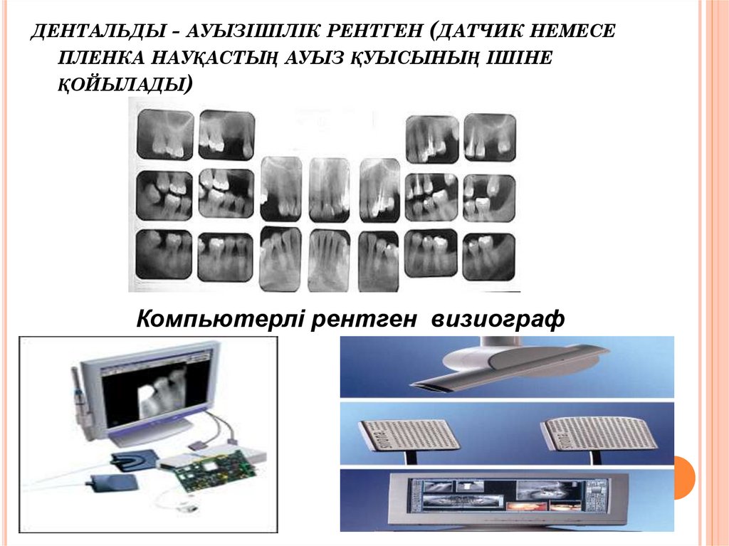 дентальды - ауызішілік рентген (датчик немесе пленка науқастың ауыз қуысының ішіне қойылады)