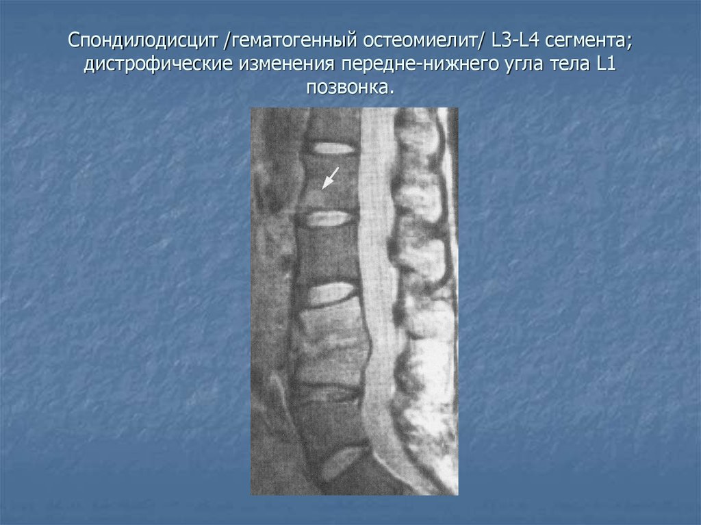 Спондилодисцит. Спондилит спондилодисцит. Асептический спондилодисцит позвоночника. Спондилодисцит позвоночника мрт. Остеомиелит позвонков кт.