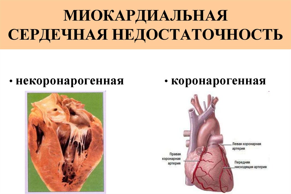 Миокардиальная сердечная недостаточность. Сердечная недостаточность миокардиальная форма. Механизм развития миокардиальной сердечной недостаточности. Миокардиальная форма сердечной недостаточности патофизиология. Миокардиальная форма сердечной недостаточности развивается при.