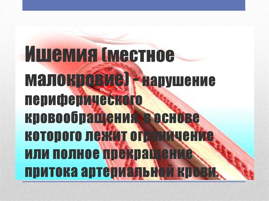 Ишемия (местное малокровие) - нарушение периферического кровообращения, в основе которого лежит ограничение или полное