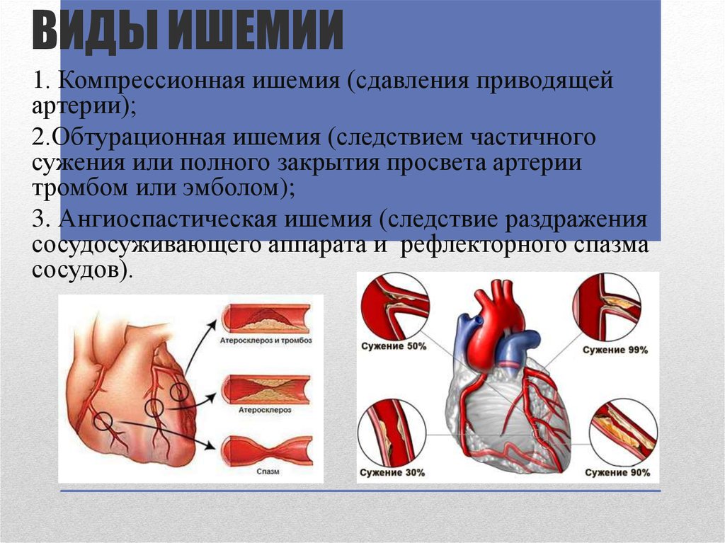 Причины ишемии миокарда