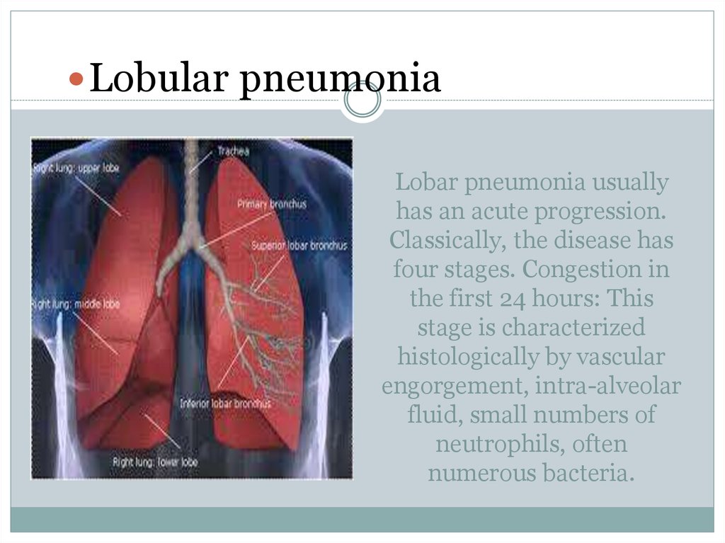Lobar pneumonia usually has an acute progression. Classically, the disease has four stages. Congestion in the first 24 hours: