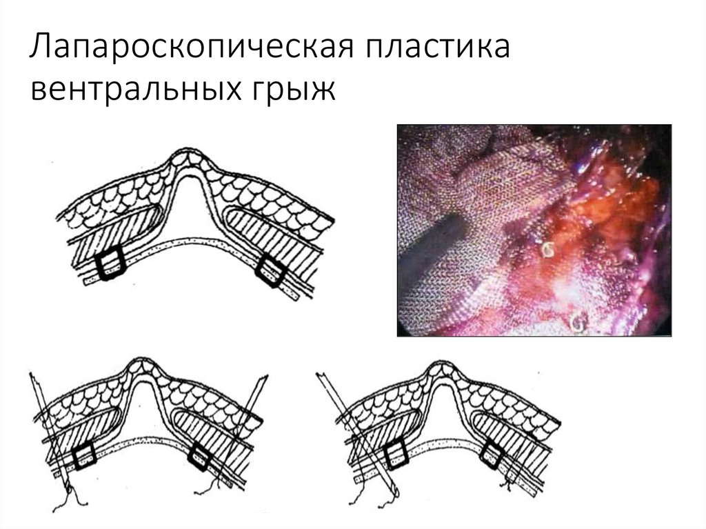 Пластика грыж. Пластика вентральной грыжи. Вентральная грыжа пластика сеткой. Пластика вентральной грыжи Inlay. Лапароскопическая сетка вентральных грыж.