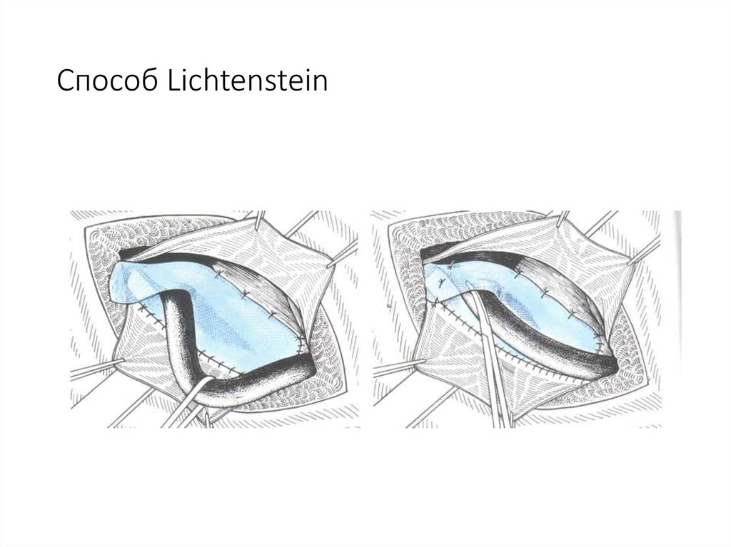 Лихтенштейн операция паховая
