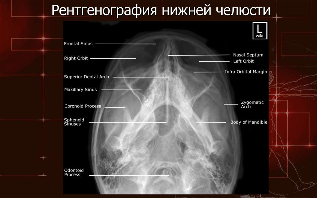 Снимок нижнего. Рентген нижней челюсти укладка. Анатомия нижней челюсти рентген. Рентгенография челюсти укладка. Нижняя челюсть укладка рентген Кишковский.