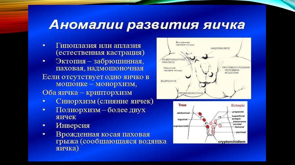 Презентация аномалии яичек