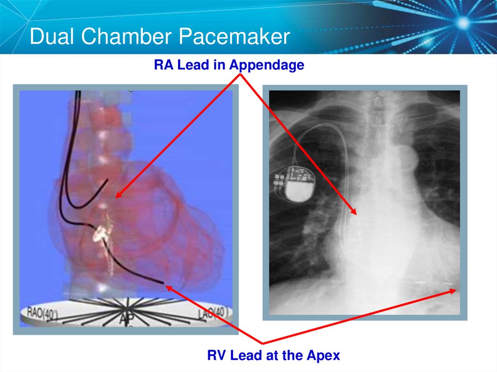 Dual Chamber Pacemaker