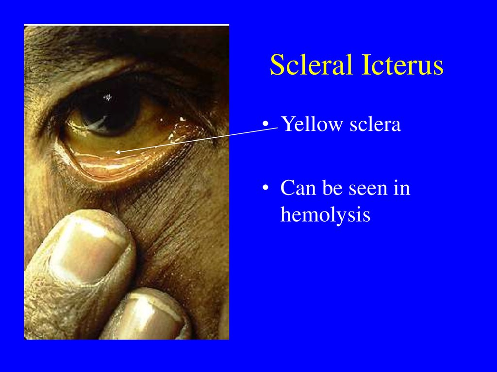 scleral icterus