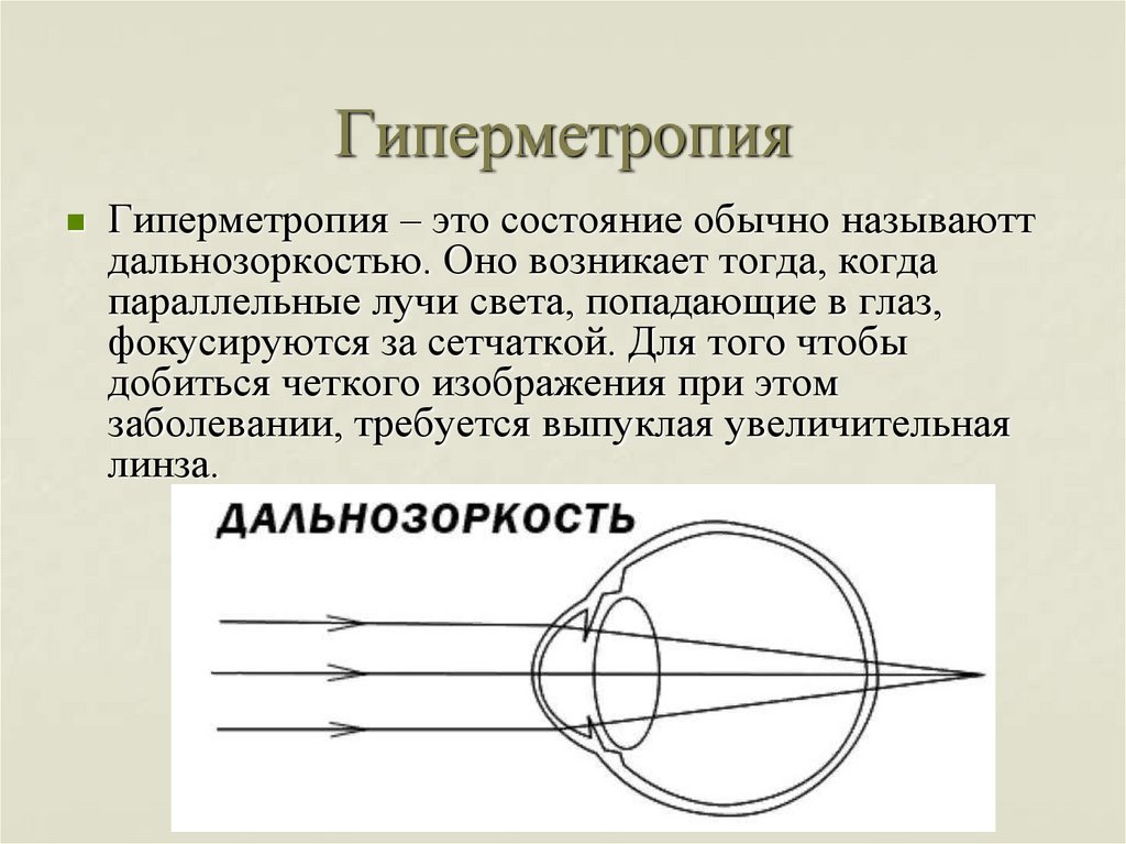 Где возникает изображение при близорукости