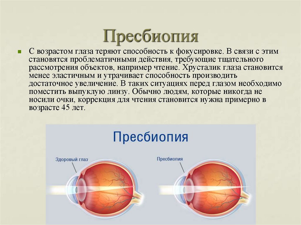 Операция при дальнозоркости. Миопия гиперметропия астигматизм пресбиопия. Факогенная миопия. Причины развития близорукости и дальнозоркости. Миопический астигматизм пресбиопия очки.