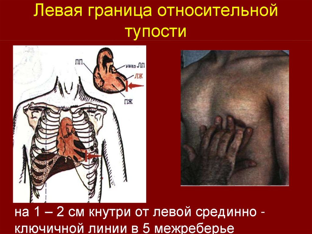 Левая граница. Левая граница относительной тупости. Границы относительной тупости легких. Легочное сердце границы относительной тупости. Границы левой относительной тупости.