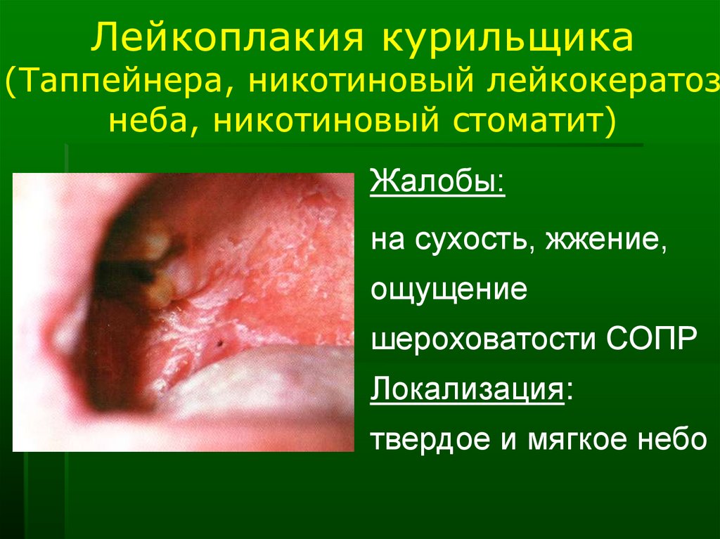 Лейкокератоз языка фото