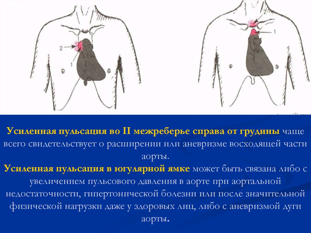 Видна пульсация. Пульсация в грудной клетке справа. Пульсирует в грудной клетке справа. Пульсация во втором межреберье справа. Пульсация аорты справа от грудины.