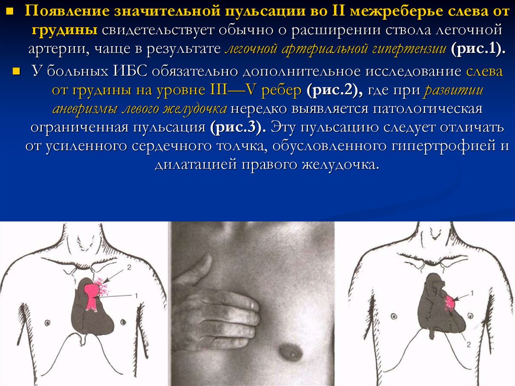 Видна пульсация. Пульсация в 3-4 межреберье слева от грудины. Пульсация в грудной клетке слева. Пульсация во II межреберье слева от грудины. Пульсирует слева в грудной клетке.
